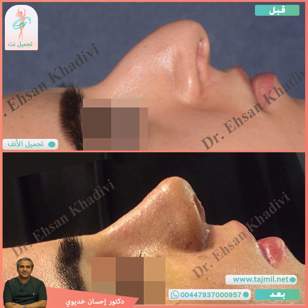  - دکتور إحسان خدیوي عملية تجميل الانف في ايران مع تجميل نت