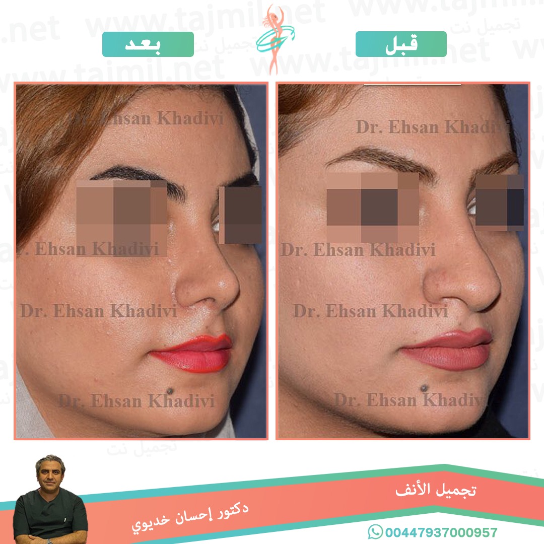  - دکتور إحسان خدیوي عملية تجميل الانف في ايران مع تجميل نت