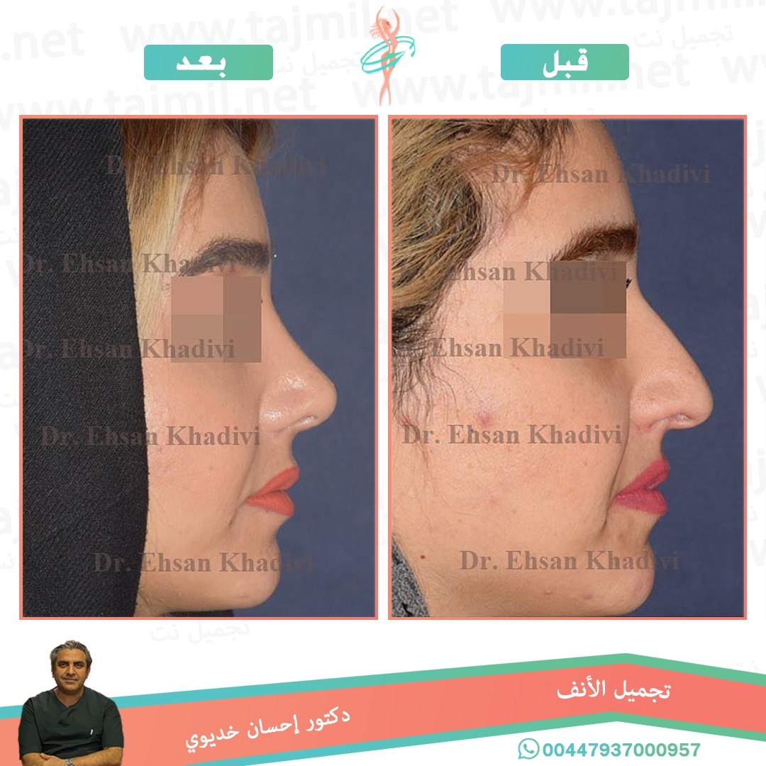  - دکتور إحسان خدیوي عملية تجميل الانف في ايران مع تجميل نت