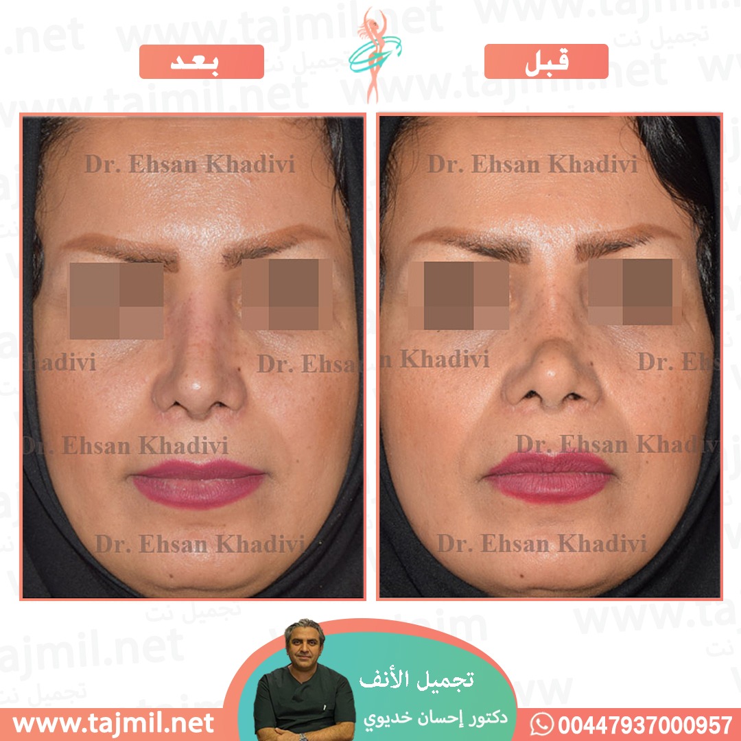  - دکتور إحسان خدیوي عملية تجميل الانف في ايران مع تجميل نت