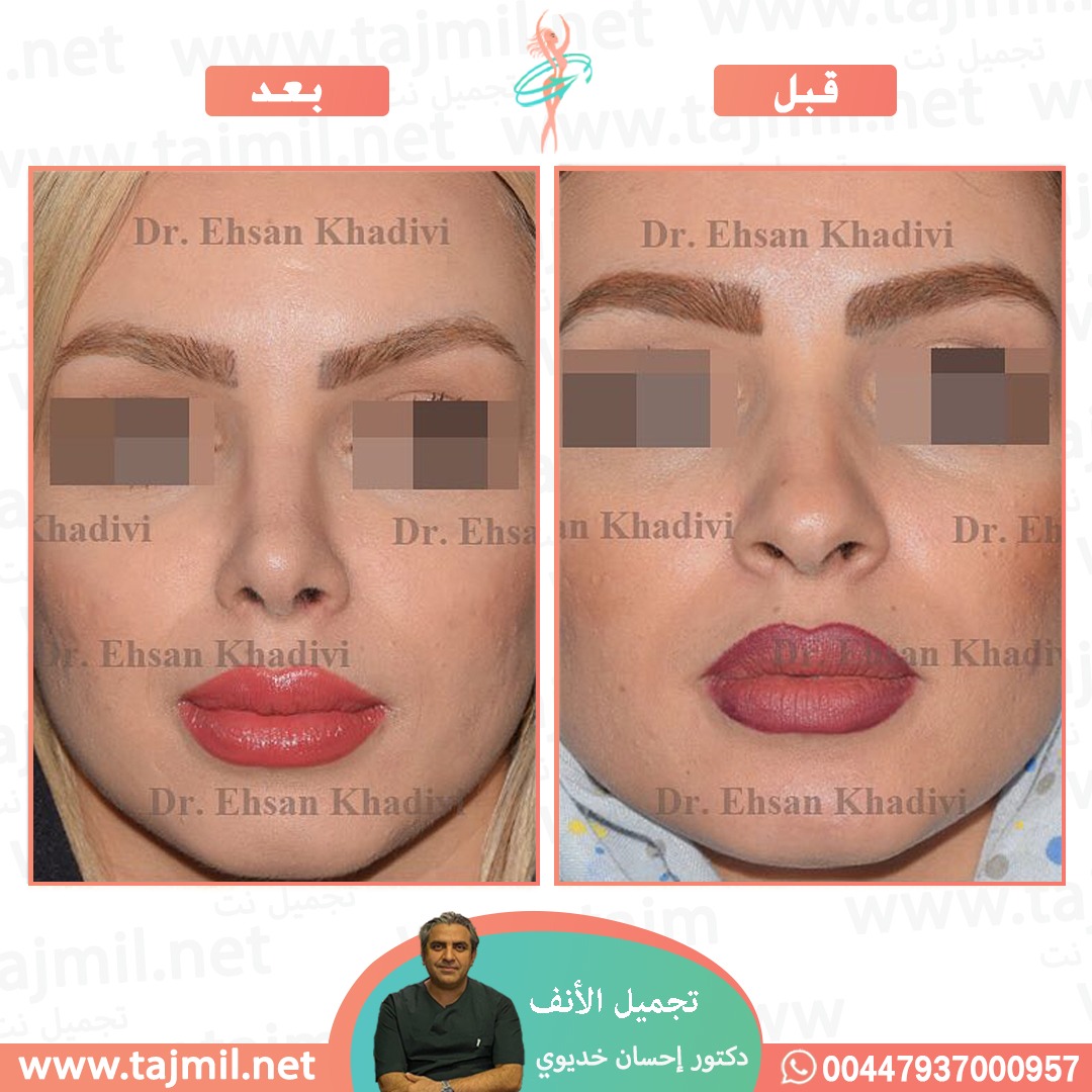  - دکتور إحسان خدیوي عملية تجميل الانف في ايران مع تجميل نت