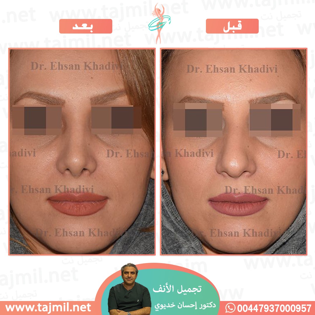  - دکتور إحسان خدیوي عملية تجميل الانف في ايران مع تجميل نت