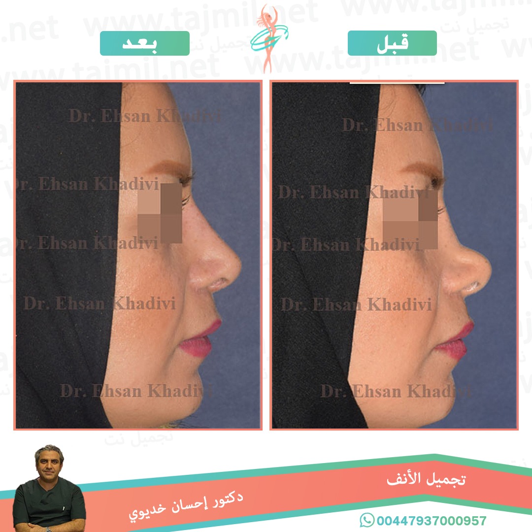  - دکتور إحسان خدیوي عملية تجميل الانف في ايران مع تجميل نت