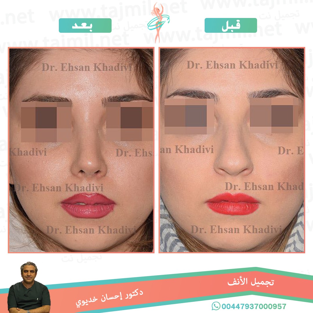  - دکتور إحسان خدیوي عملية تجميل الانف في ايران مع تجميل نت