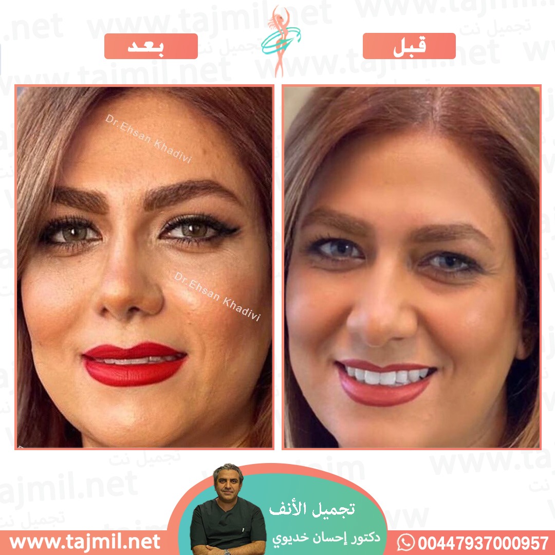  - دکتور إحسان خدیوي عملية تجميل الانف في ايران مع تجميل نت