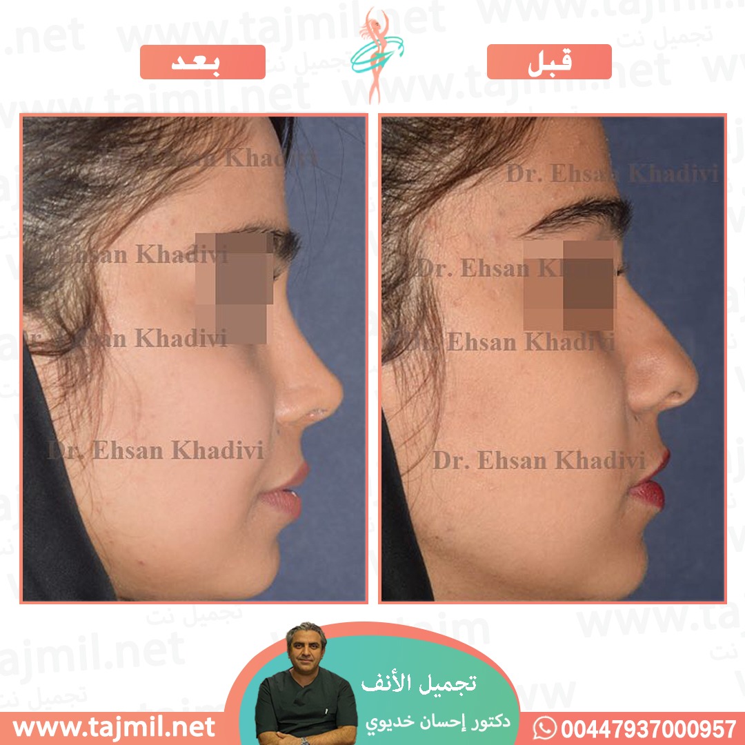  - دکتور إحسان خدیوي عملية تجميل الانف في ايران مع تجميل نت