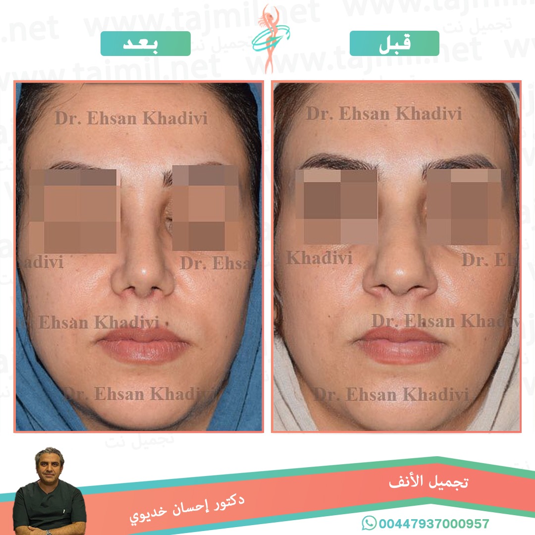  - دکتور إحسان خدیوي عملية تجميل الانف في ايران مع تجميل نت