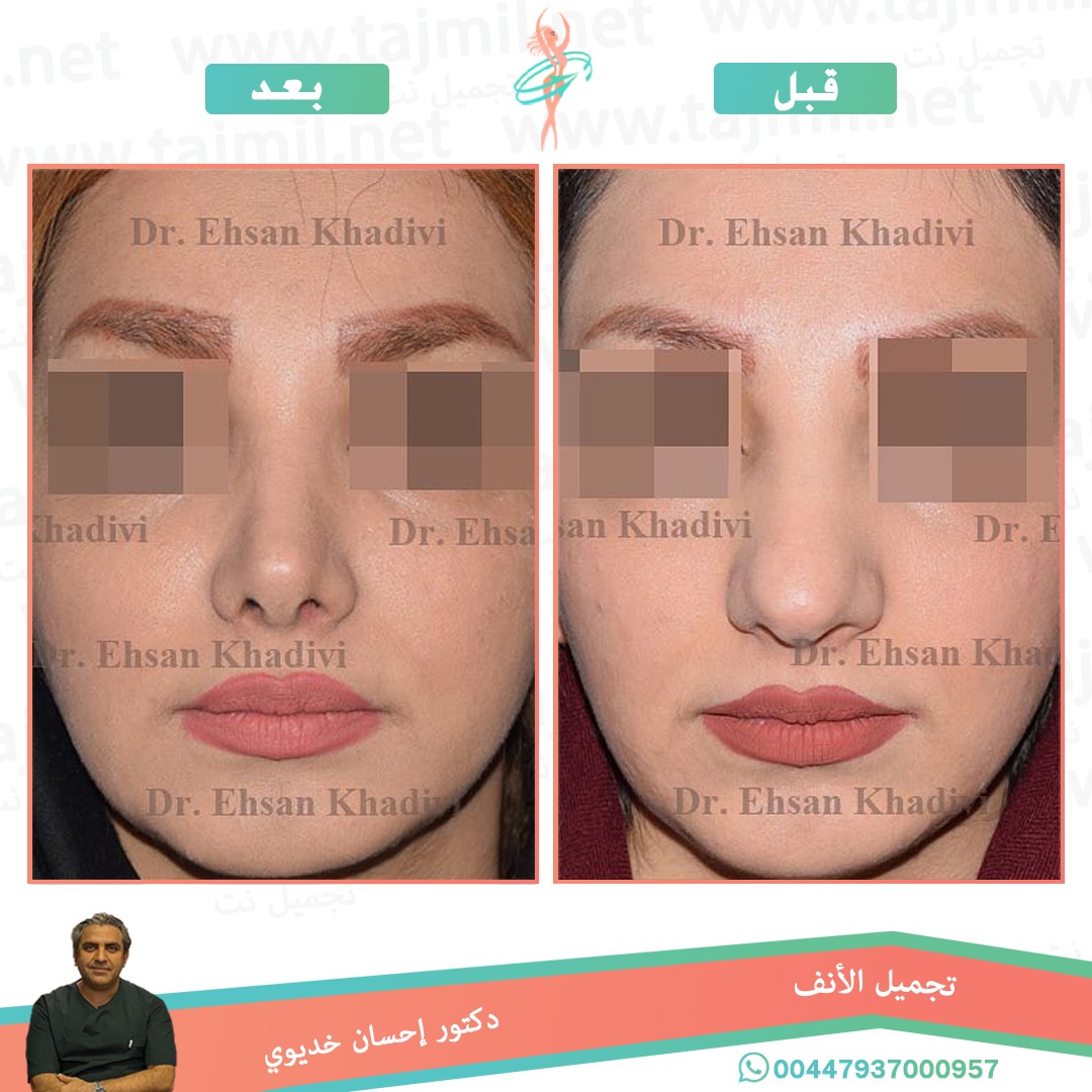  - دکتور إحسان خدیوي عملية تجميل الانف في ايران مع تجميل نت