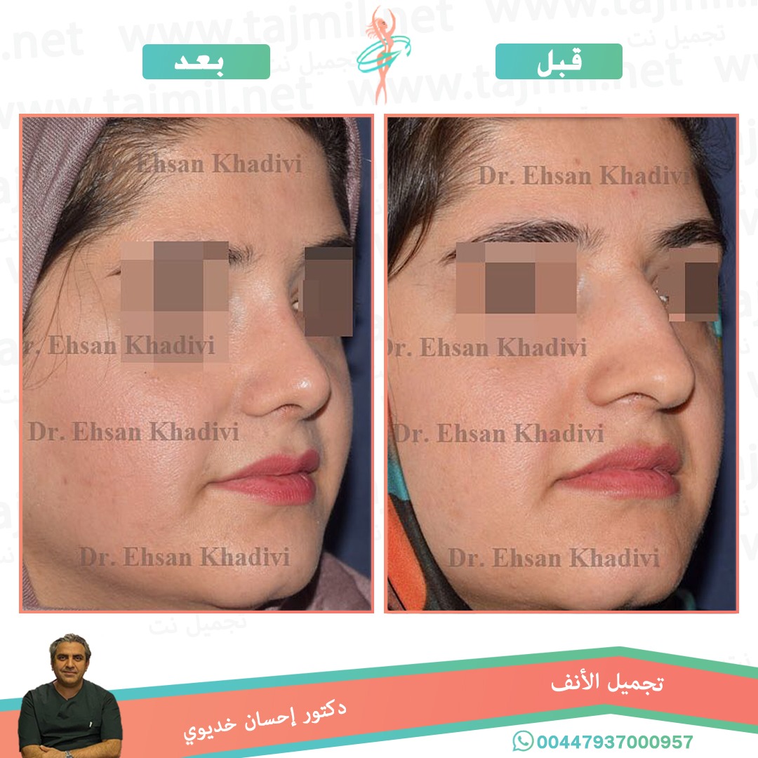  - دکتور إحسان خدیوي عملية تجميل الانف في ايران مع تجميل نت