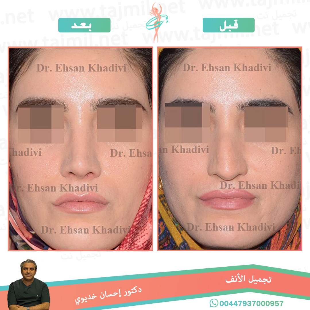  - دکتور إحسان خدیوي عملية تجميل الانف في ايران مع تجميل نت