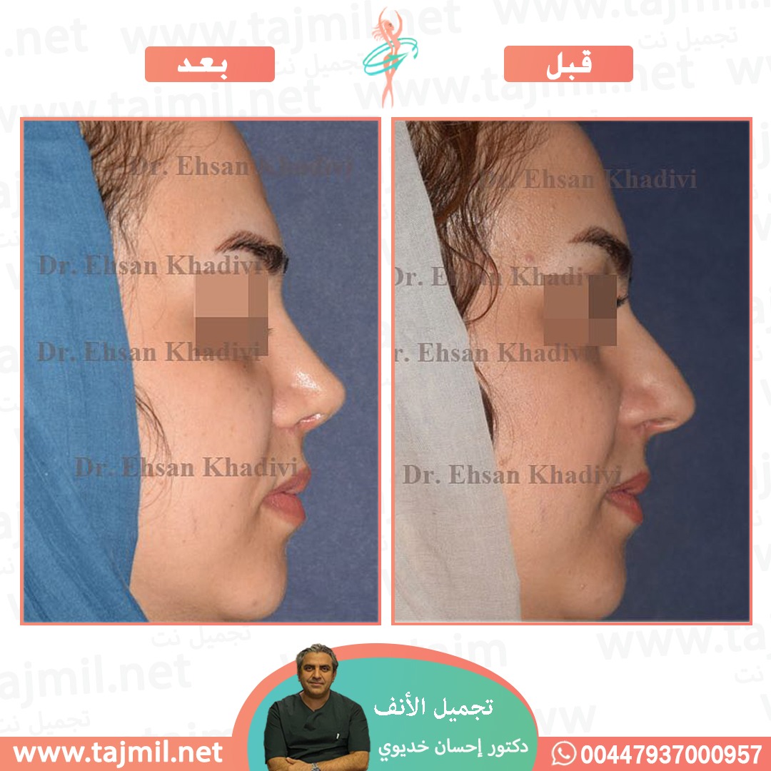  - دکتور إحسان خدیوي عملية تجميل الانف في ايران مع تجميل نت