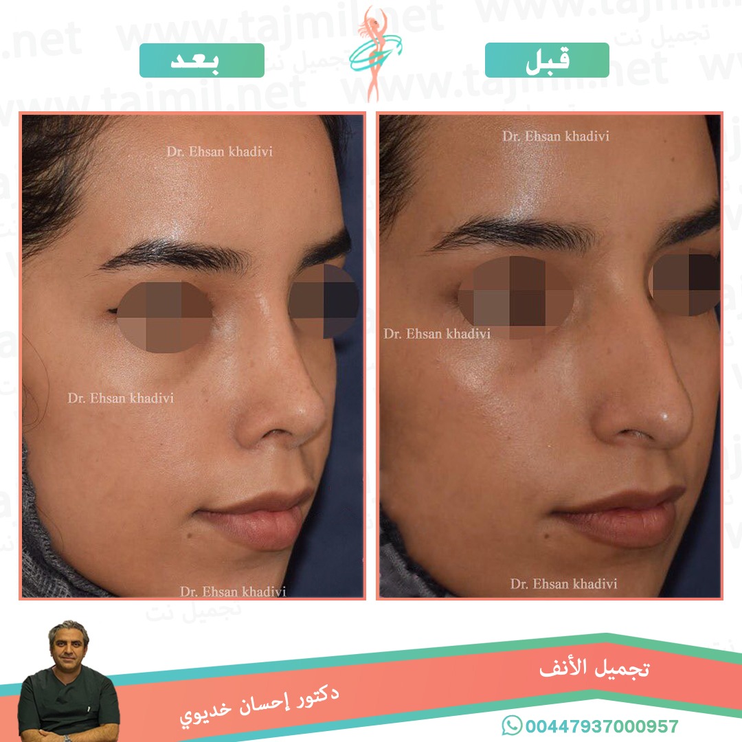  - دکتور إحسان خدیوي عملية تجميل الانف في ايران مع تجميل نت