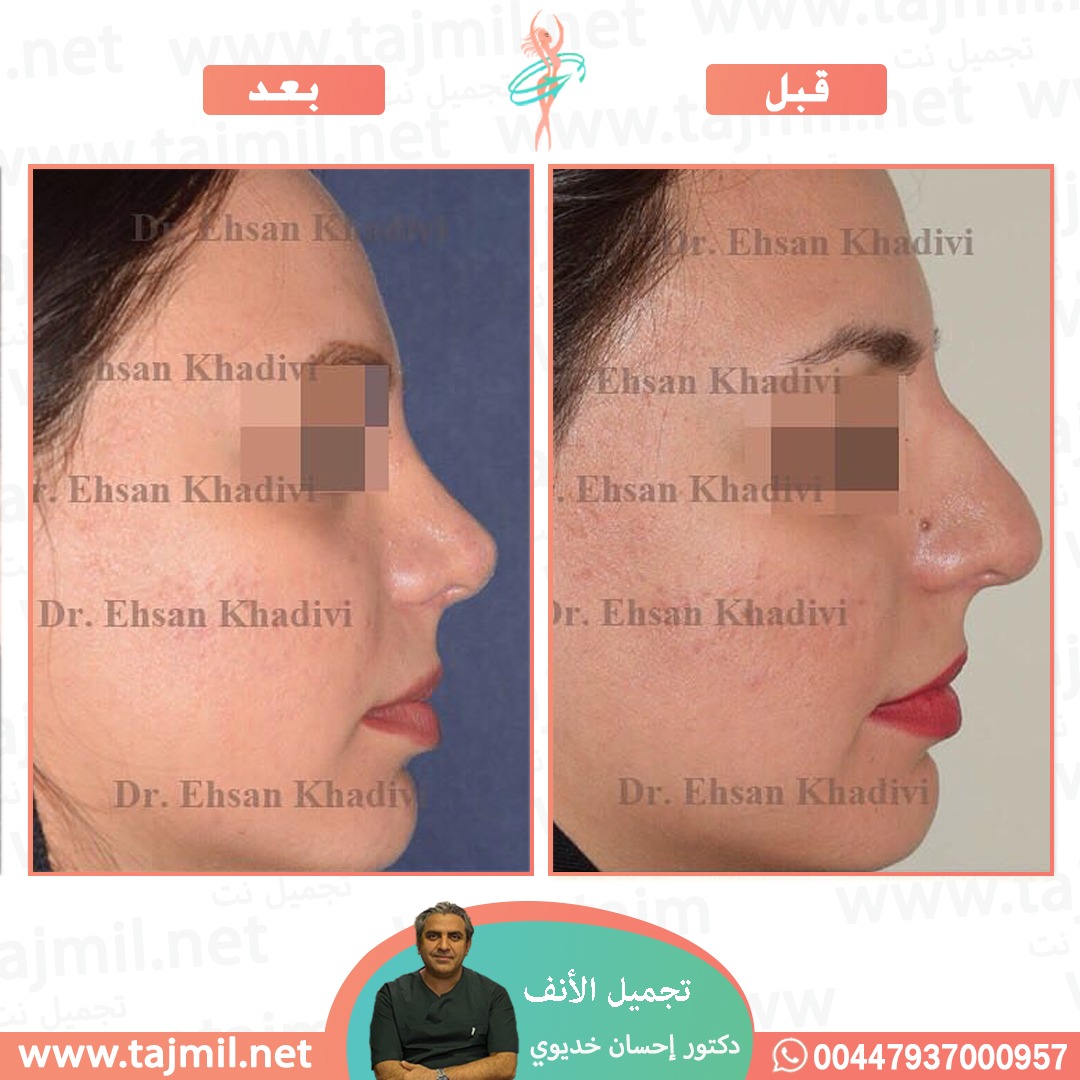  - دکتور إحسان خدیوي عملية تجميل الانف في ايران مع تجميل نت