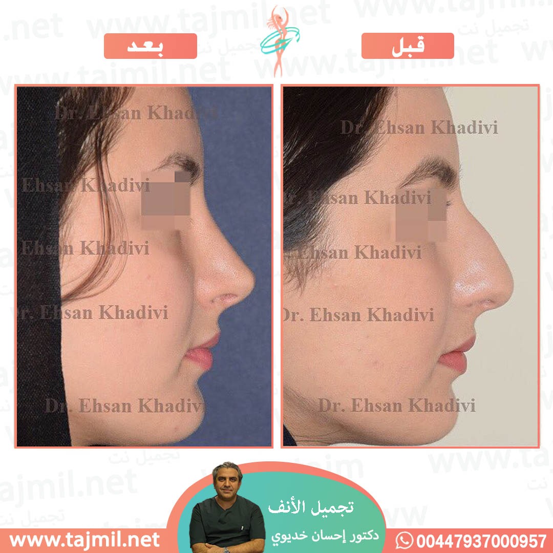  - دکتور إحسان خدیوي عملية تجميل الانف في ايران مع تجميل نت