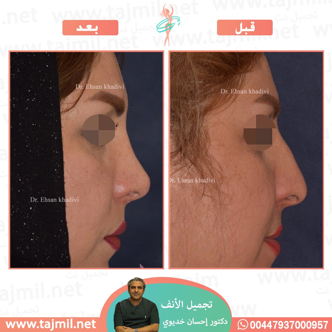  - دکتور إحسان خدیوي عملية تجميل الانف في ايران مع تجميل نت