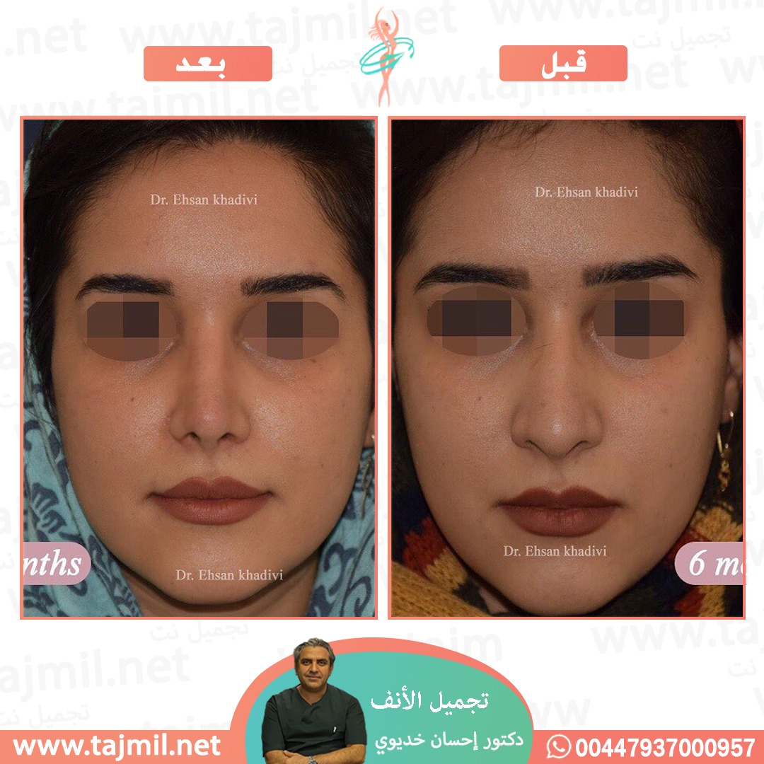  - دکتور إحسان خدیوي عملية تجميل الانف في ايران مع تجميل نت