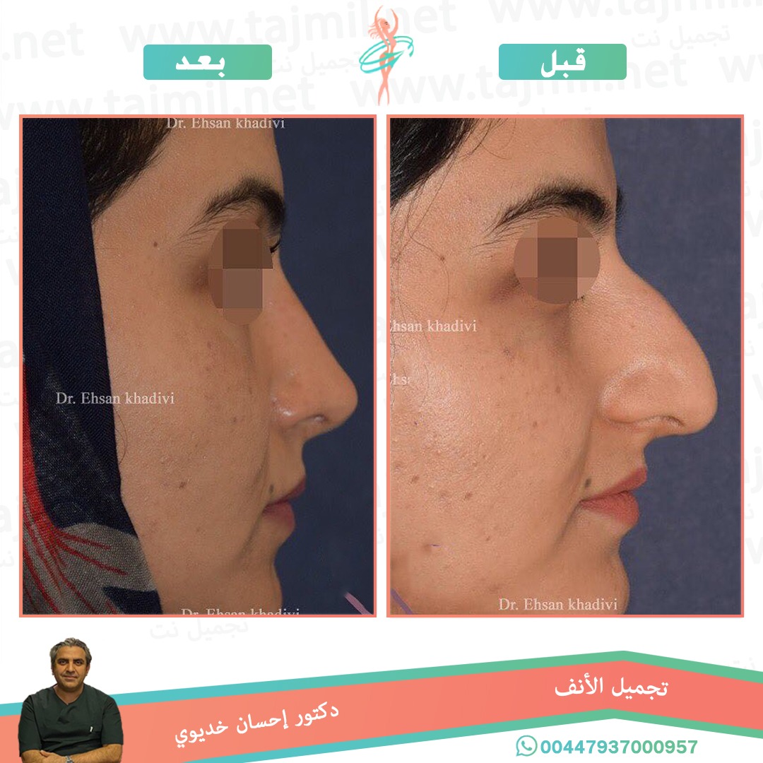  - دکتور إحسان خدیوي عملية تجميل الانف في ايران مع تجميل نت