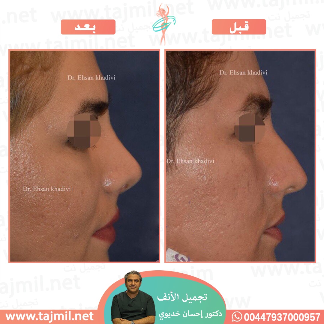  - دکتور إحسان خدیوي عملية تجميل الانف في ايران مع تجميل نت