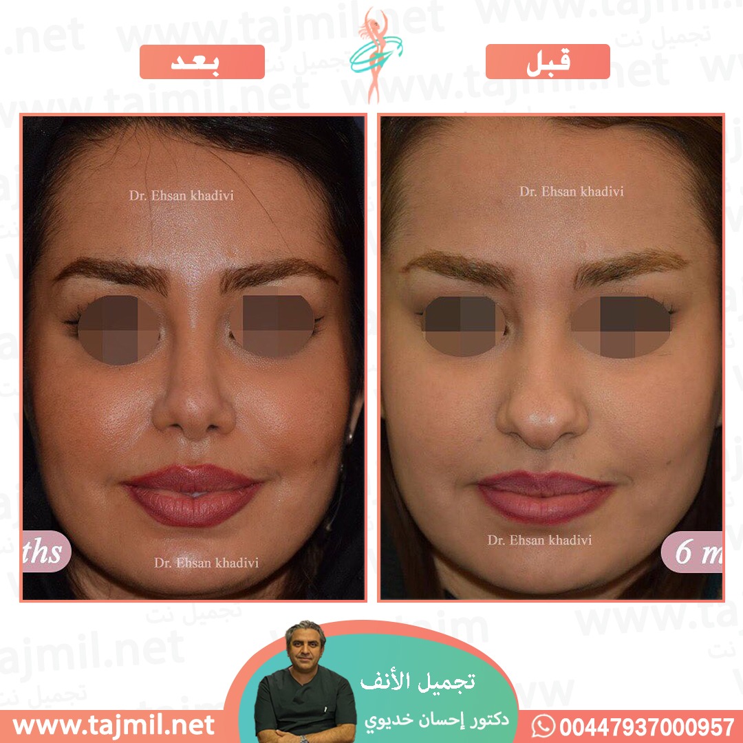  - دکتور إحسان خدیوي عملية تجميل الانف في ايران مع تجميل نت