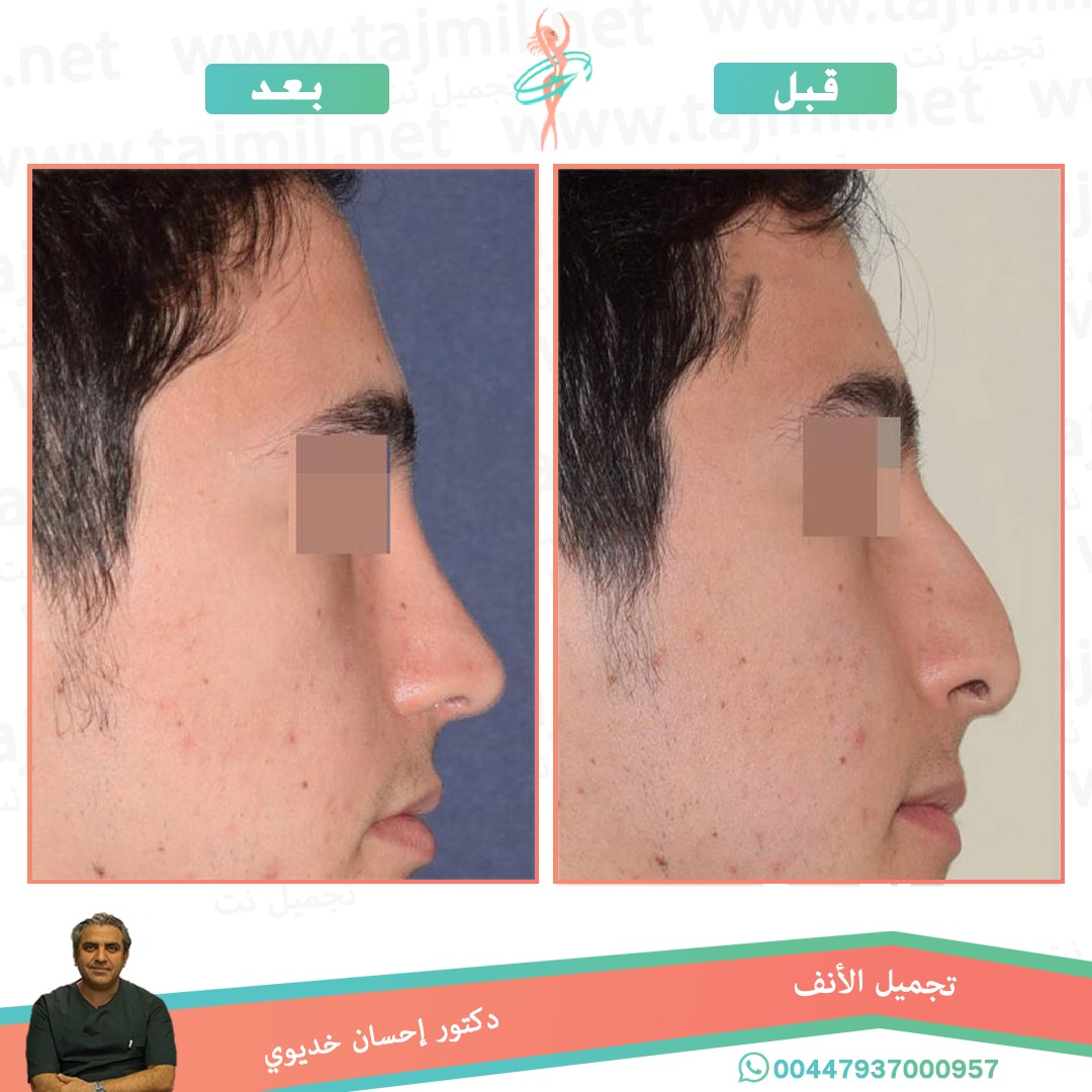  - دکتور إحسان خدیوي عملية تجميل الانف في ايران مع تجميل نت