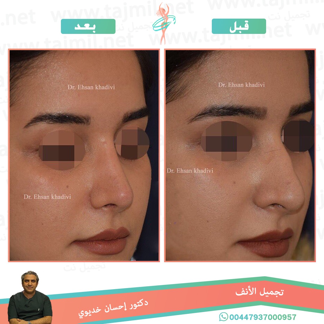  - دکتور إحسان خدیوي عملية تجميل الانف في ايران مع تجميل نت