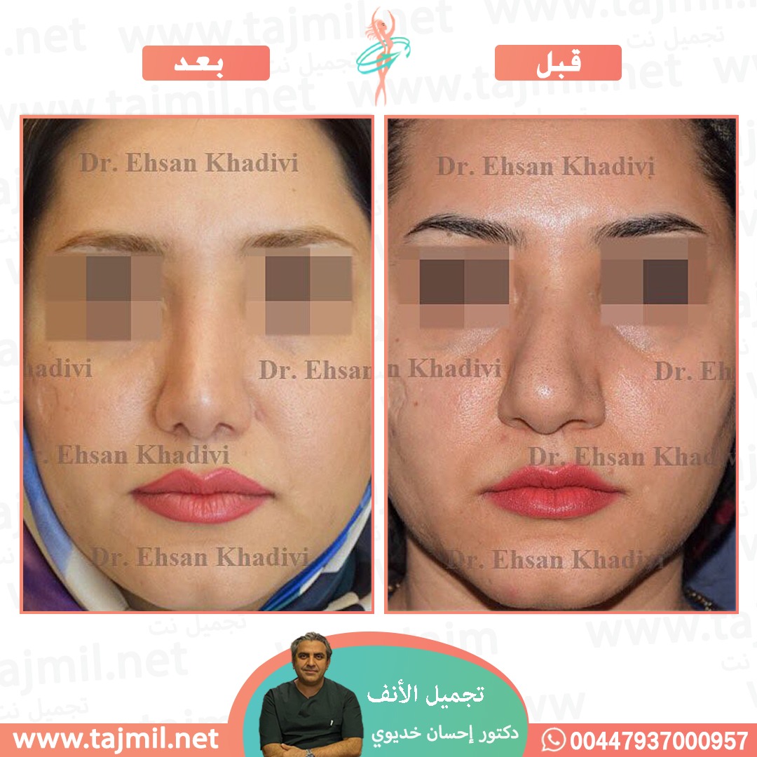  - دکتور إحسان خدیوي عملية تجميل الانف في ايران مع تجميل نت