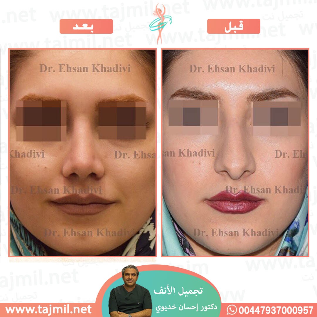  - دکتور إحسان خدیوي عملية تجميل الانف في ايران مع تجميل نت