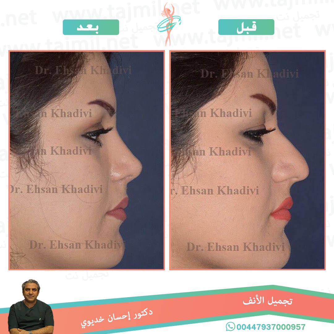  - دکتور إحسان خدیوي عملية تجميل الانف في ايران مع تجميل نت