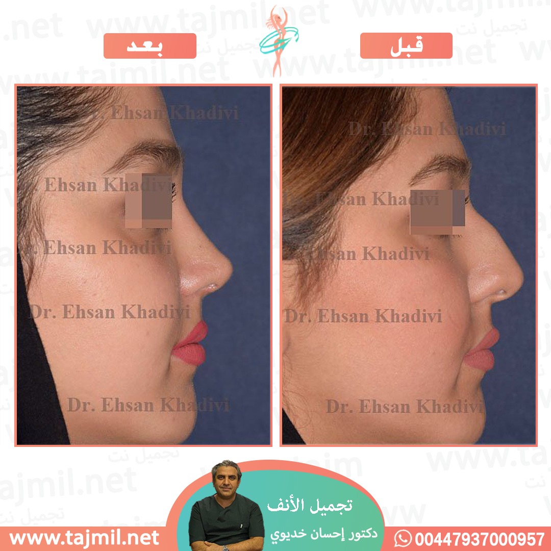  - دکتور إحسان خدیوي عملية تجميل الانف في ايران مع تجميل نت