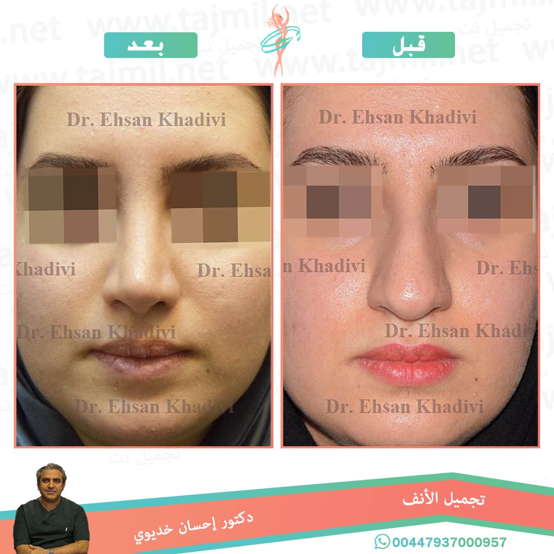  - دکتور إحسان خدیوي عملية تجميل الانف في ايران مع تجميل نت