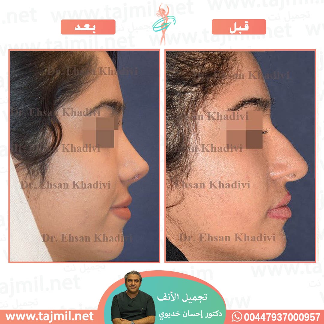  - دکتور إحسان خدیوي عملية تجميل الانف في ايران مع تجميل نت