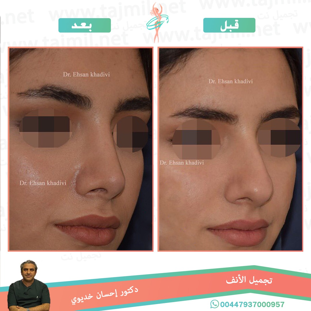  - دکتور إحسان خدیوي عملية تجميل الانف في ايران مع تجميل نت