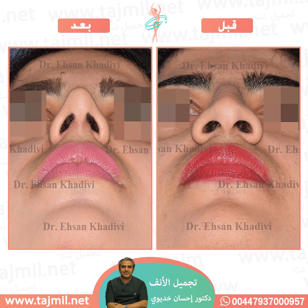  - دکتور إحسان خدیوي عملية تجميل الانف في ايران مع تجميل نت