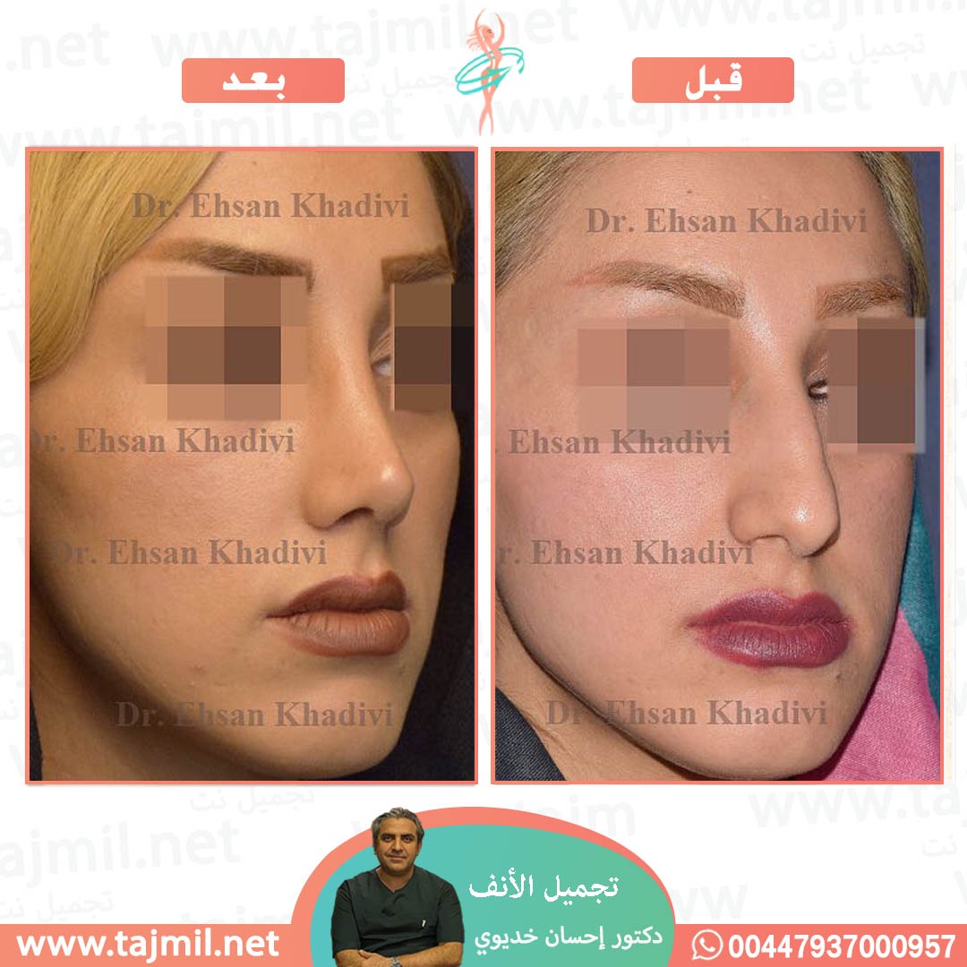  - دکتور إحسان خدیوي عملية تجميل الانف في ايران مع تجميل نت