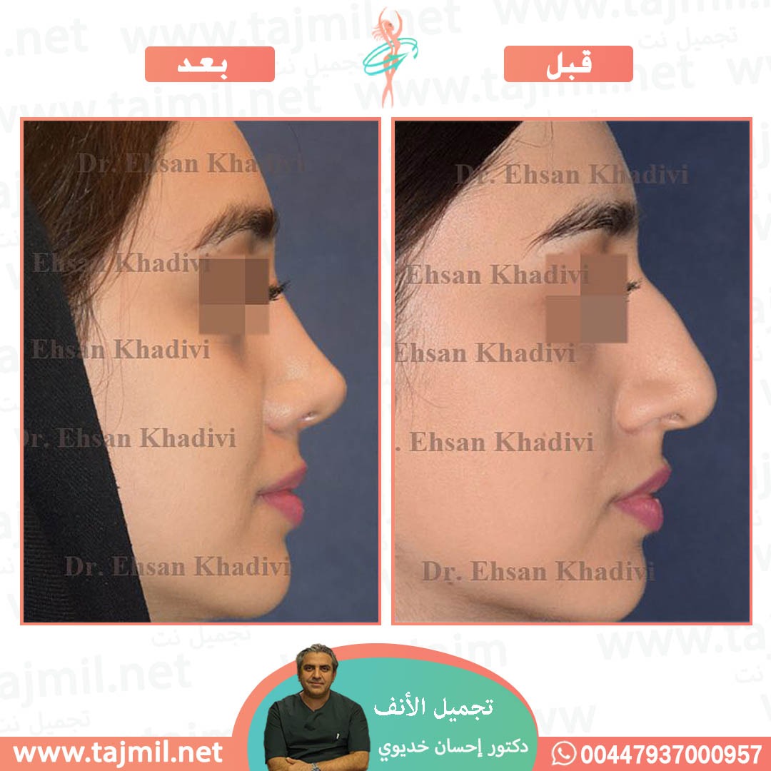  - دکتور إحسان خدیوي عملية تجميل الانف في ايران مع تجميل نت