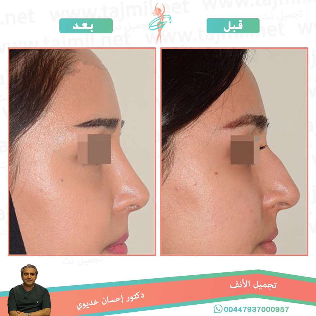  - دکتور إحسان خدیوي عملية تجميل الانف في ايران مع تجميل نت