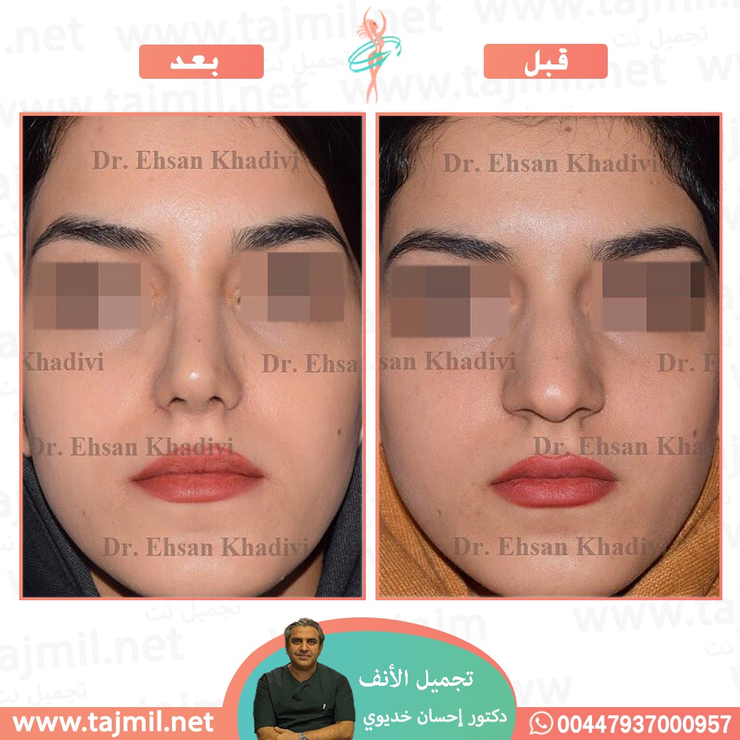  - دکتور إحسان خدیوي عملية تجميل الانف في ايران مع تجميل نت