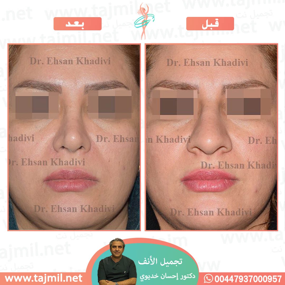  - دکتور إحسان خدیوي عملية تجميل الانف في ايران مع تجميل نت