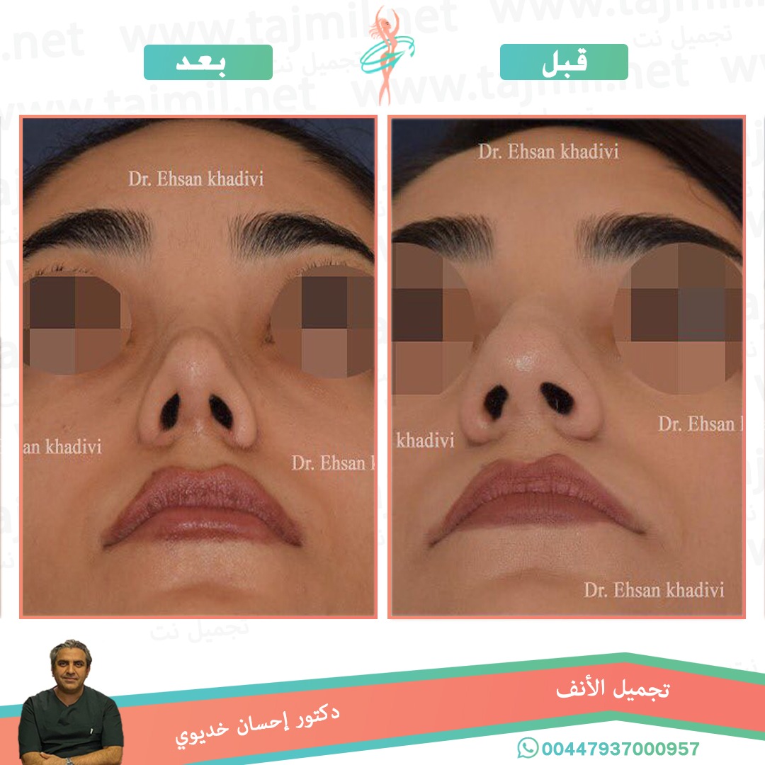  - دکتور إحسان خدیوي عملية تجميل الانف في ايران مع تجميل نت