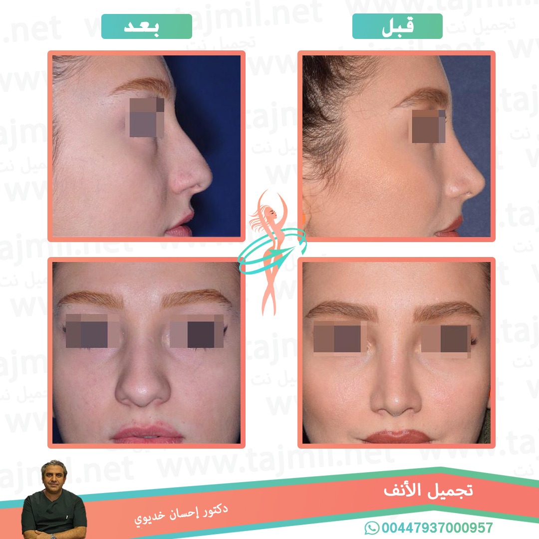  - دکتور إحسان خدیوي عملية تجميل الانف في ايران مع تجميل نت