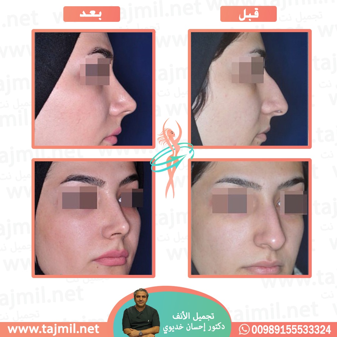  - دکتور إحسان خدیوي عملية تجميل الانف في ايران مع تجميل نت