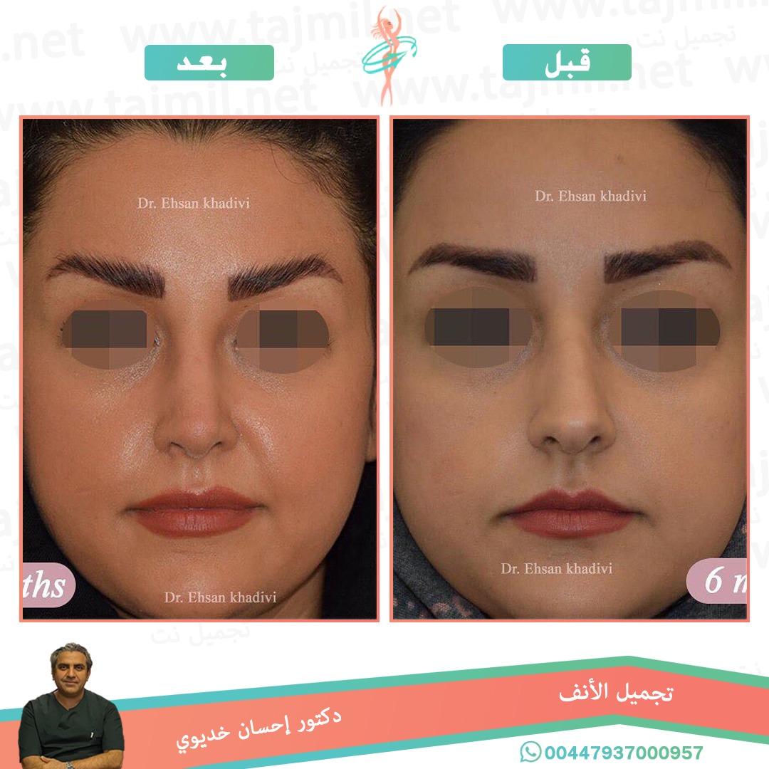  - دکتور إحسان خدیوي عملية تجميل الانف في ايران مع تجميل نت