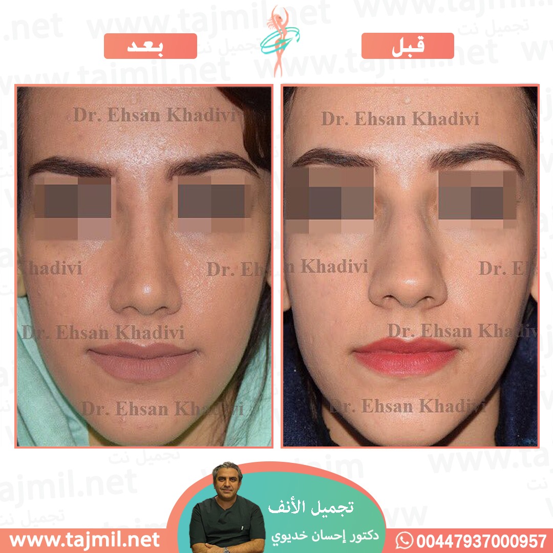  - دکتور إحسان خدیوي عملية تجميل الانف في ايران مع تجميل نت