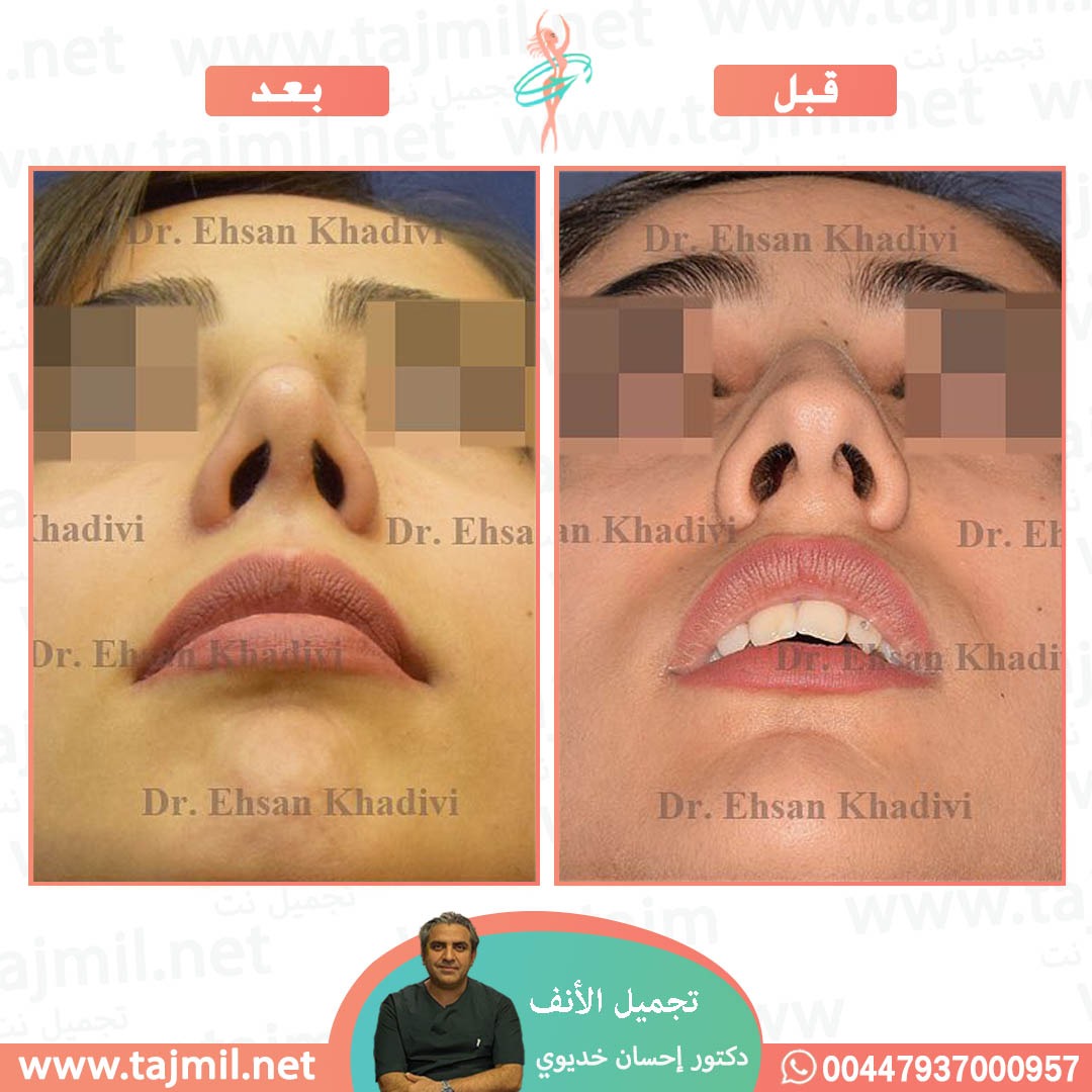  - دکتور إحسان خدیوي عملية تجميل الانف في ايران مع تجميل نت