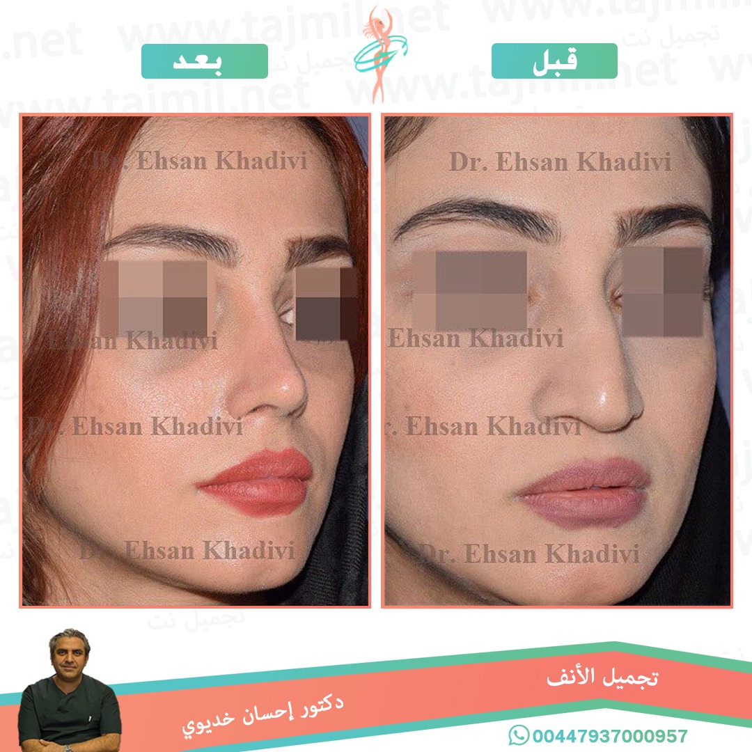  - دکتور إحسان خدیوي عملية تجميل الانف في ايران مع تجميل نت