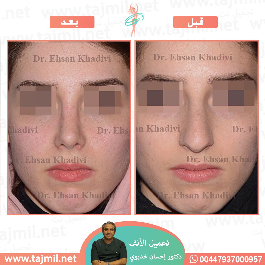  - دکتور إحسان خدیوي عملية تجميل الانف في ايران مع تجميل نت