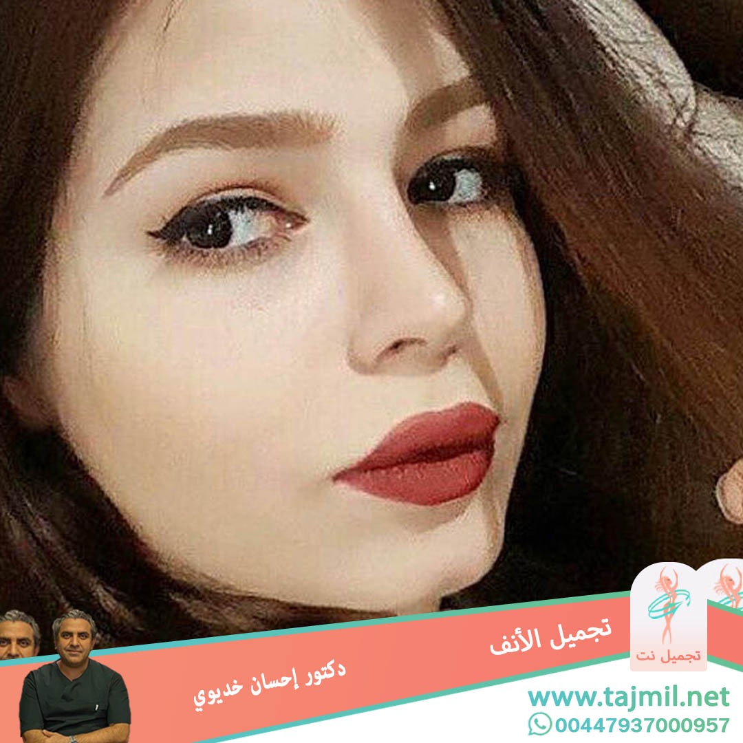  - دکتور إحسان خدیوي عملية تجميل الانف في ايران مع تجميل نت