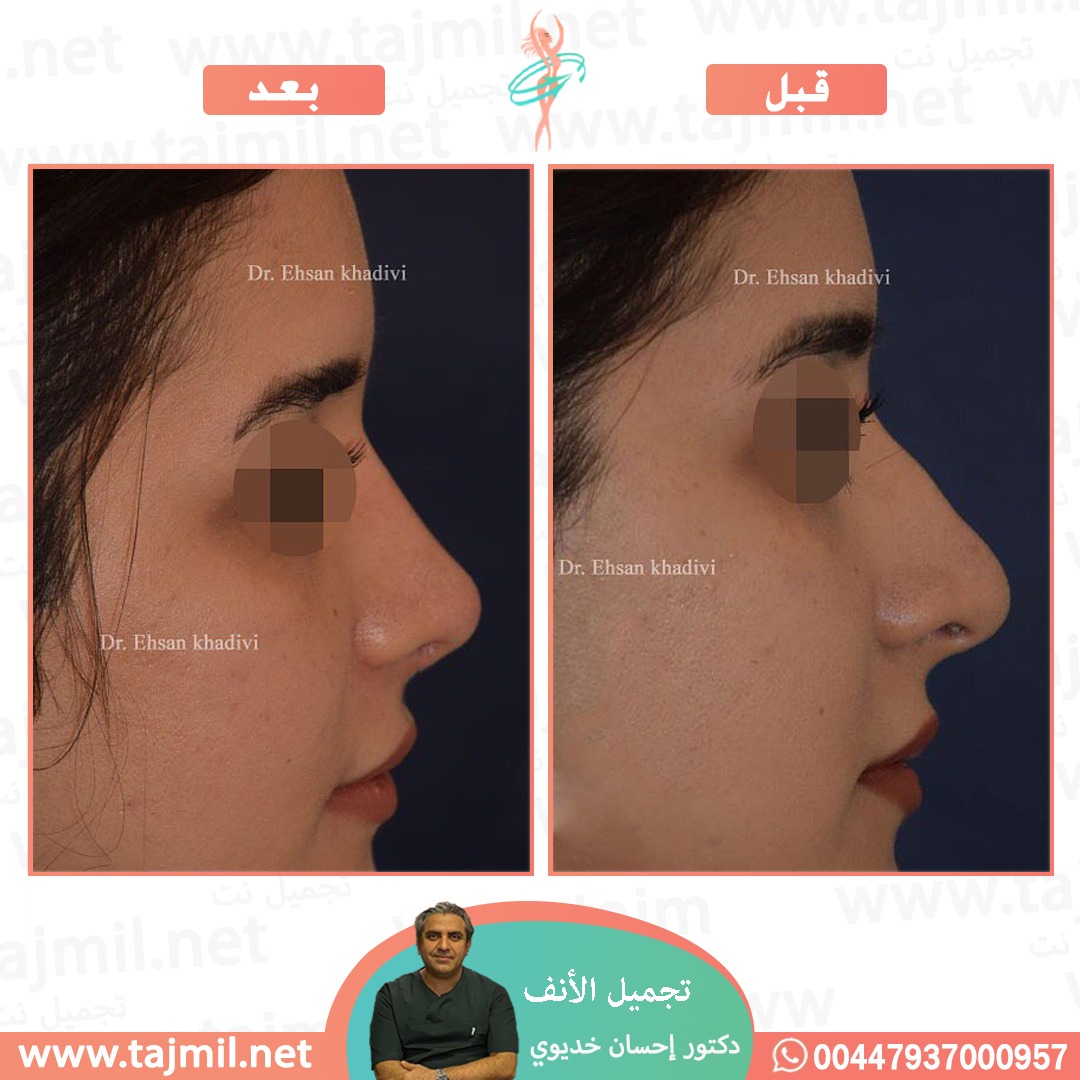  - دکتور إحسان خدیوي عملية تجميل الانف في ايران مع تجميل نت