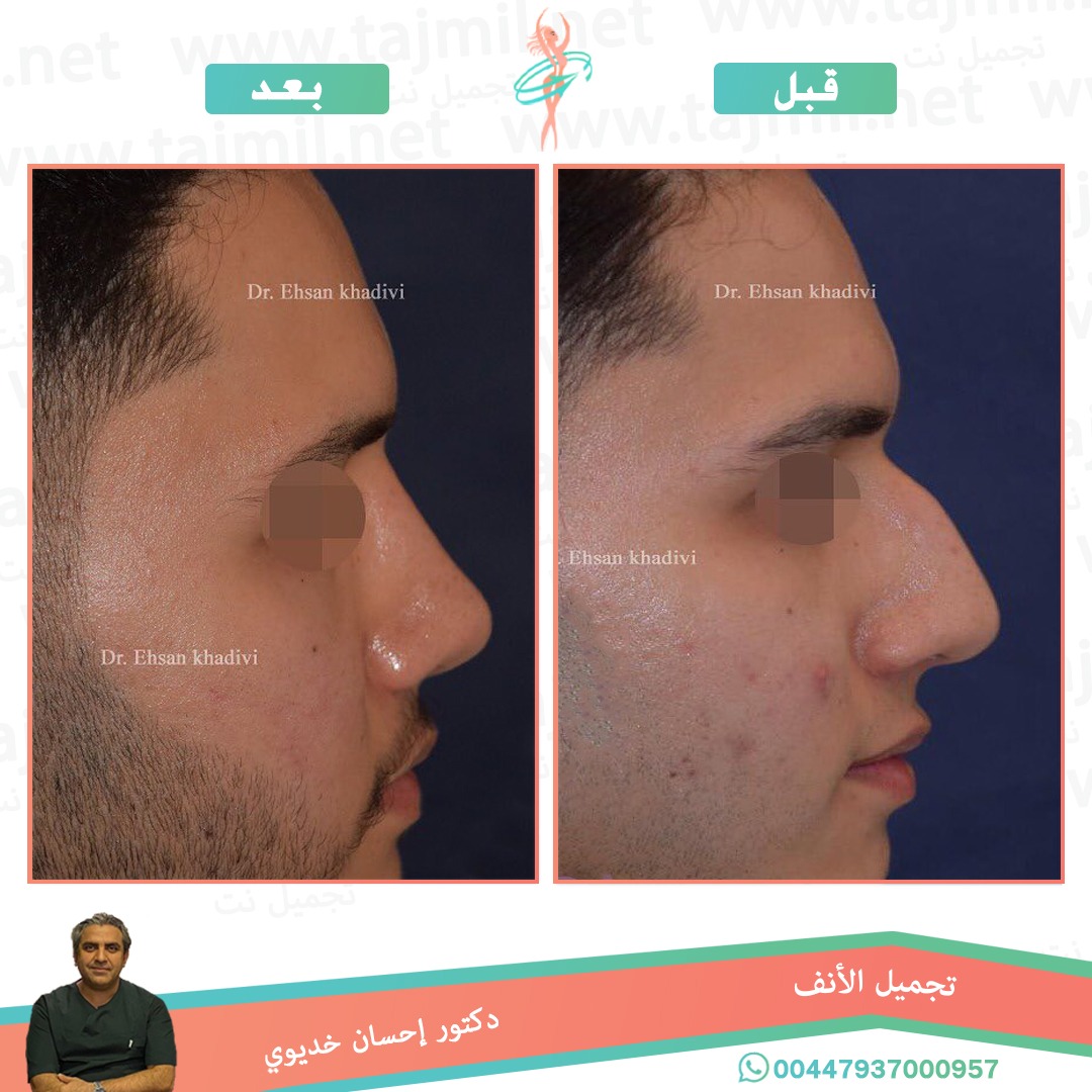  - دکتور إحسان خدیوي عملية تجميل الانف في ايران مع تجميل نت