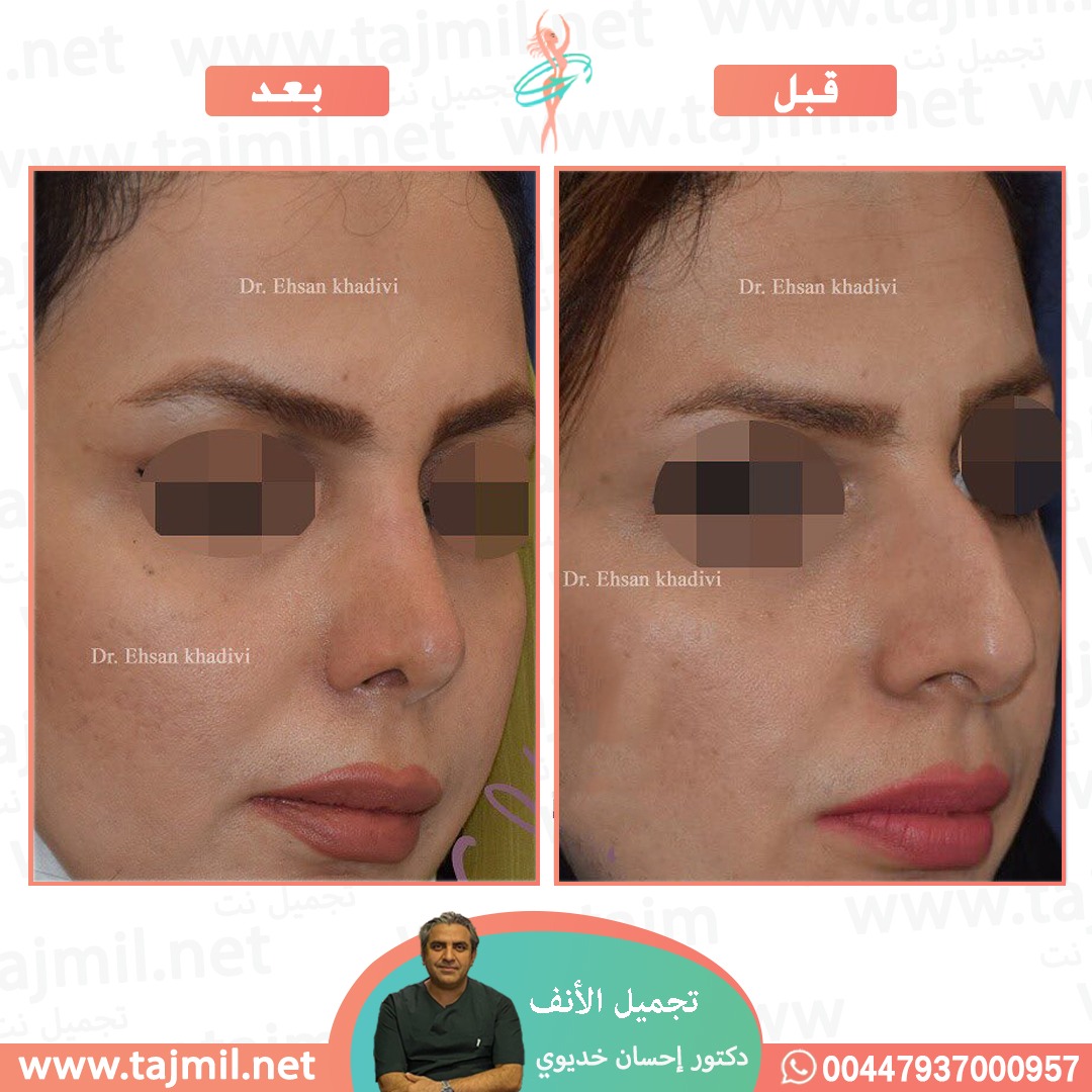  - دکتور إحسان خدیوي عملية تجميل الانف في ايران مع تجميل نت